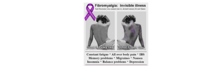The Effects of Shiatsu in the Management of Fibromyalgia